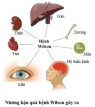 BỆNH RỐI LOẠN CHUYỂN HÓA ĐỒNG (BỆNH WILSON)